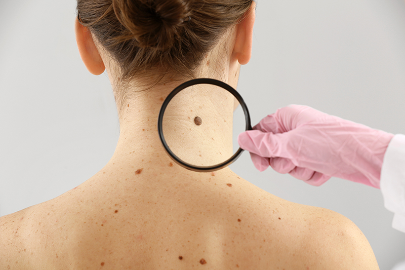 dermatologist,examining,moles,of,patient,on,light,background