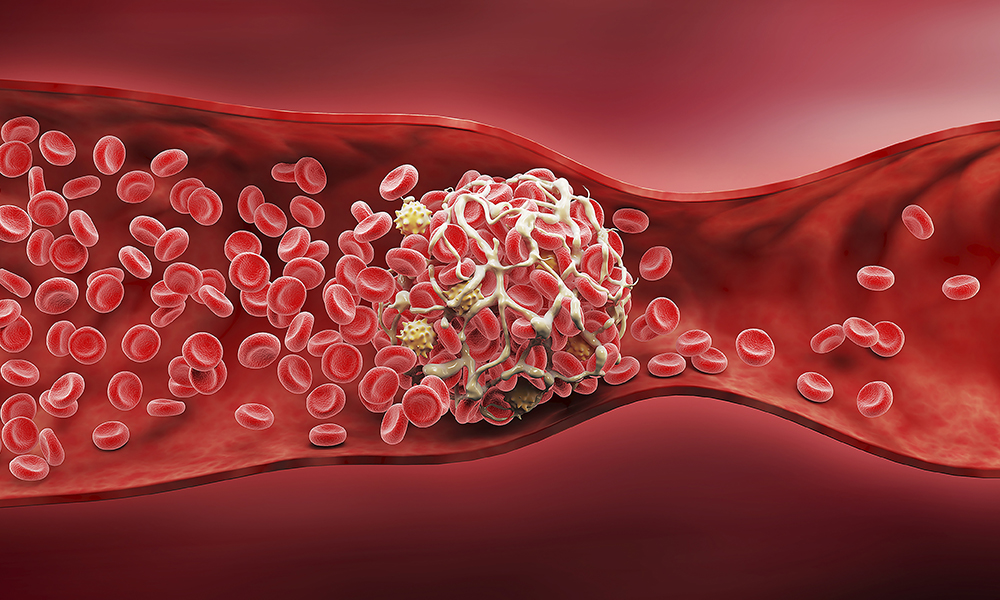 3d,illustration,of,a,blood,clot,,thickened,arteries,and,veins,