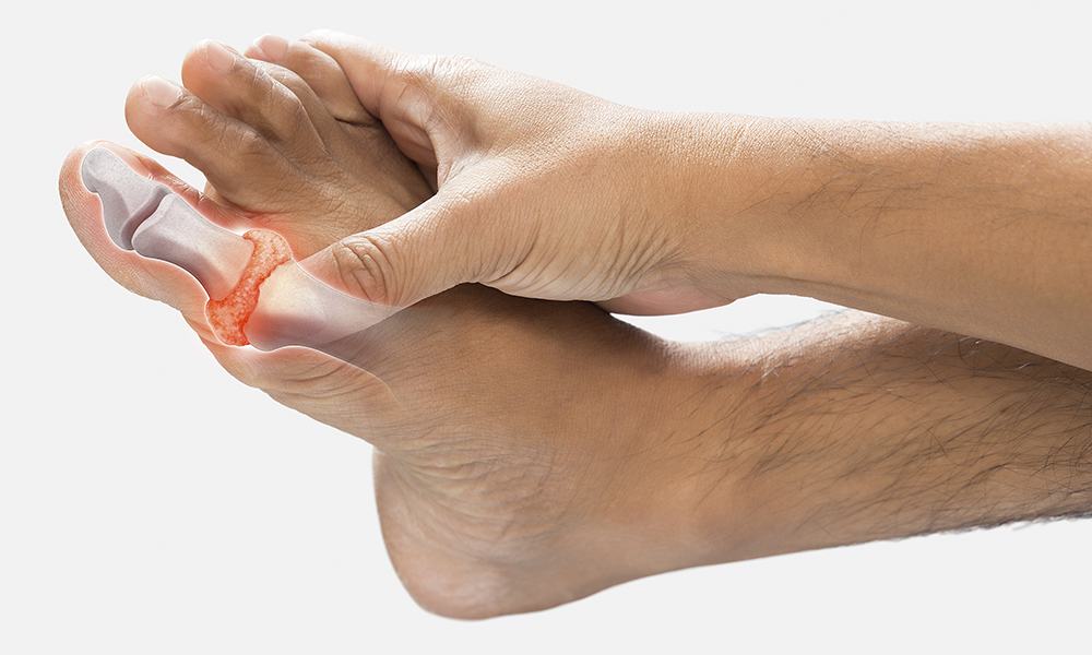 high,levels,of,uric,acid,in,men's,toes,bones,on