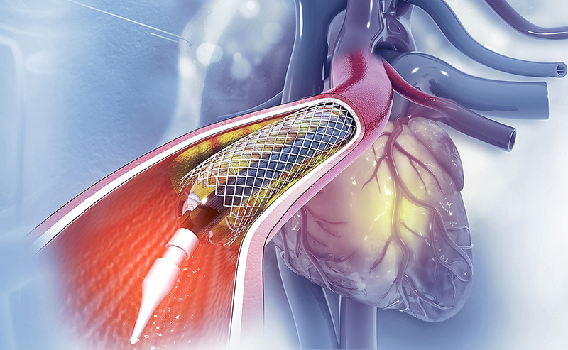 balloon,angioplasty,procedure,with,stent,in,vein.3d,illustration